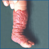 Angioma tuberoso de pierna