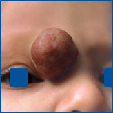 Angioma tubero-cavernoso naso-palpebral