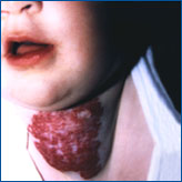 Angioma tuberoso-cavernoso de cuello